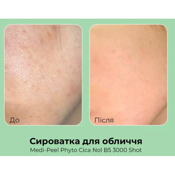 Сироватка-пілінг для чутливої та проблемної шкіри Medi-Peel Phyto Cica-nol B5 3,000 Shot Serum 50 г Сироватка-пілінг для чутливої та проблемної шкіри Medi-Peel Phyto Cica-nol B5 3,000 Shot Serum 50 г